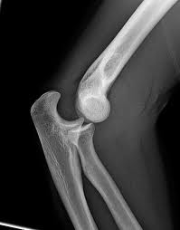 istoric fractura cotului tratează inflamația articulațiilor piciorului