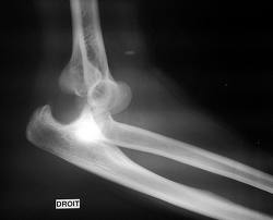 deformarea degetelor și dureri articulare colagen cartilaj de rechin