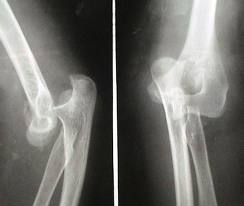 artrita simptomelor degetului cum să alinați durerea în articulațiile genunchilor