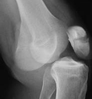 fractură a articulației genunchiului fără tratament de deplasare