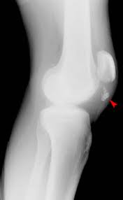 fractura genunchi