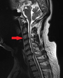 Operatii pe coloana vertebrala