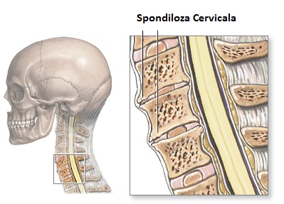 spondiloza artroza cervicala