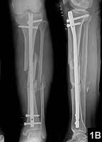 tratamente pentru artroza genunchiului condroitina pret