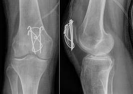 fractura genunchi