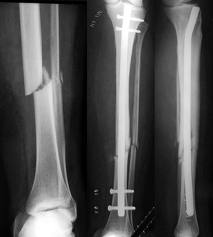 operatie tibie cu tija cum să elimini durerea acută în articulația genunchiului