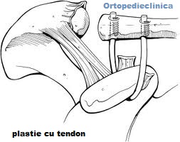 Artroza acromio-claviculara | Chirurgia umarului, cotului si a genunchiului