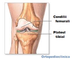 tratamentul fracturilor articulare rupe articulațiile decât tratamentul