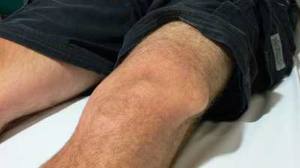 dislocarea genunchiului tratament pentru artroza la picioare