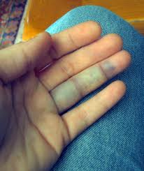 dureri articulare după o mică fractură de deget