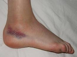 Simptome și metode de tratare a unei fisuri în oasele picioarelor - Tratament