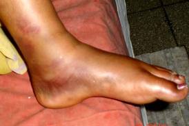 refacerea piciorului după fractura de gleznă)