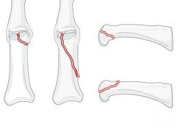 care este util pentru artrita genunchiului