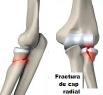 tratamentul fracturii radiale la cot)