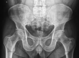 artroza deformanta primara scrasnet si durere la genunchi tratament