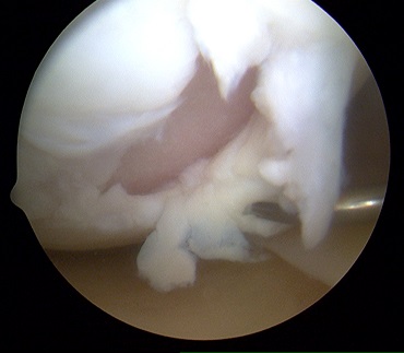 restaurarea cartilajului hialin al articulației șoldului