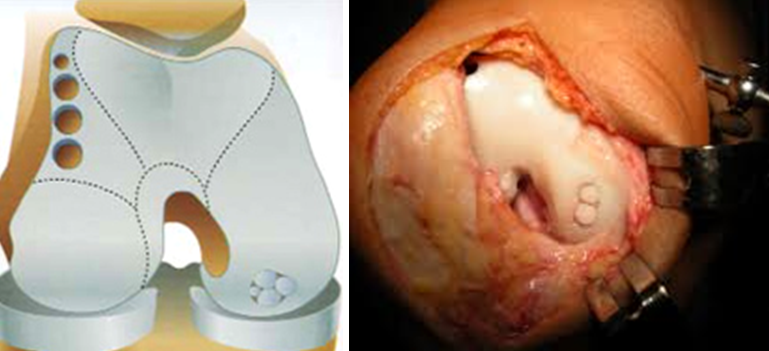 leziuni ale cartilajelor genunchiului dacă durerea în articulația umărului
