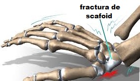 Fractura osului scafoid