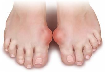 tratament pentru guta picior inflamație articulară datorată metabolismului