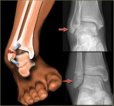 medicamente pentru tratamentul articulațiilor genunchiului dureri de picioare la nivelul articulației unde șoldul