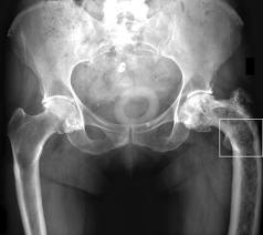 artroza tratamentului medicamentos de gradul 3 dureri articulare la genunchi în spate