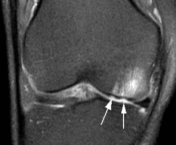 tratamentul artritei de gradul 1 al articulației genunchiului