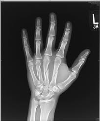 Tratamentul fără deplasare a fracturii de încheietura mâinii