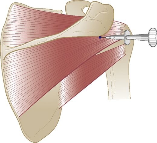 osteoartrita sterno claviculara