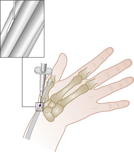 simptome de styloidită la încheietura mâinii și tratament artroza deformanta tratament