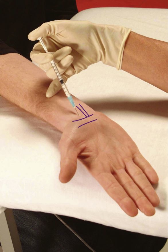 Styloidita articulației încheieturii mâinii - Rănire 