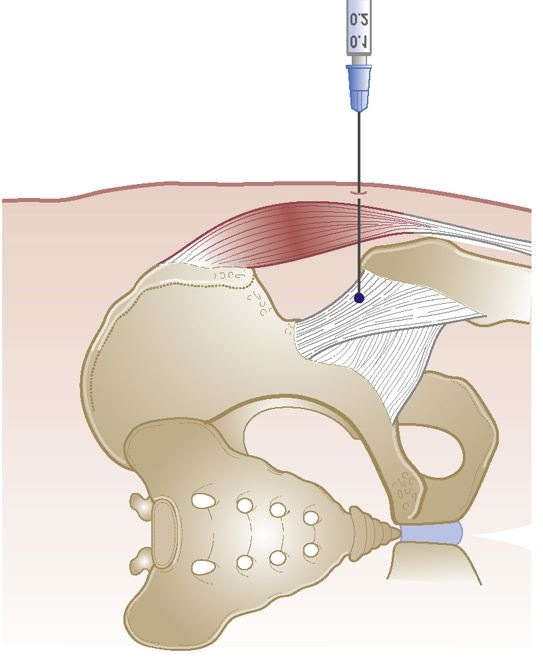 scârțâituri în articulația șoldului tablete pentru osteocondroza toracică