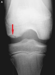 Osteocondrita disecanta a genunchiului