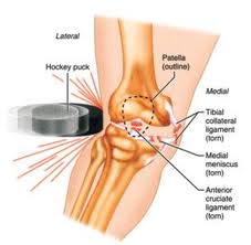 cum să tratăm osteocondrita disecantă a genunchiului