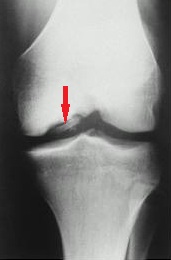 osteochondroza juvenilă a genunchiului