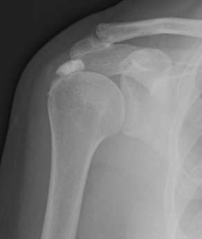 radiografie umar stang lichid în genunchi după tratamentul cu accidentare