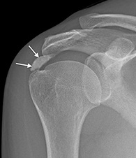 calcifierea ligamentelor tratamentului articulației șoldului tratamentul distorsiunii gleznei