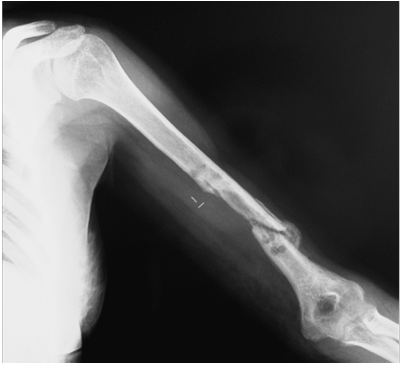pseudartroza radiologic un braț dureros în articulația cotului