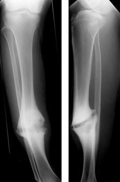pseudartroza dex dureri articulare la nivelul piciorului și pelvisului