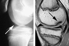 Osteochondroza juvenilă a genunchiului - Osteocondrita disecanta a genunchiului