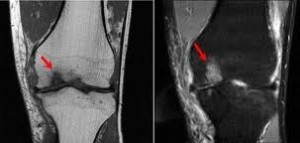 Osteocondrita disecanta a genunchiului