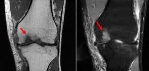 osteochondroza juvenilă a genunchiului)