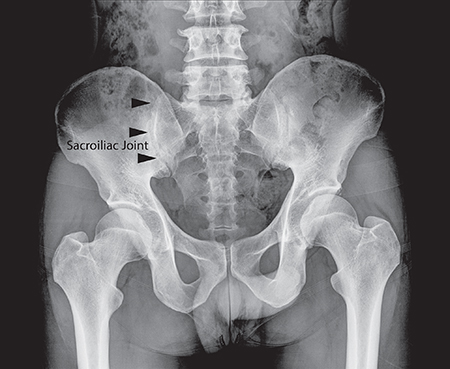 dureri articulare sacroiliace în tratamentul medical al artrozei deformante