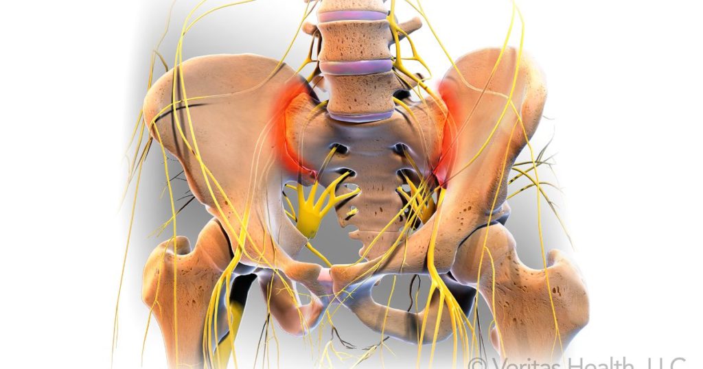 Disfunctia articulatiei sacroiliace, cauza a durerii lombare, Durerea articulației sacroiliace