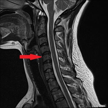 artroza vertebrală c4-c7 tratamentul coloanei vertebrale cervicale