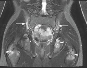 dureri articulare cu varicelă la adulți tratamentul artrozei de gradul doi al genunchiului