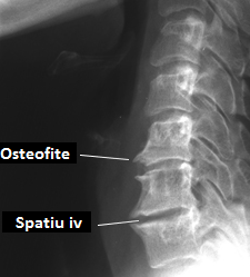 osteoartrita se manifesta leziunea predominanta a coloanei cervicale)