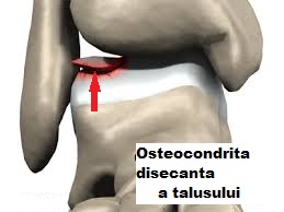 osteochondroza juvenilă a genunchiului)