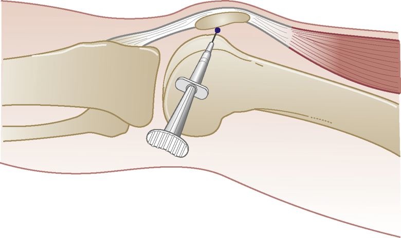 formarea tumorii la genunchi unguente în tratamentul artrozei deformante a genunchiului