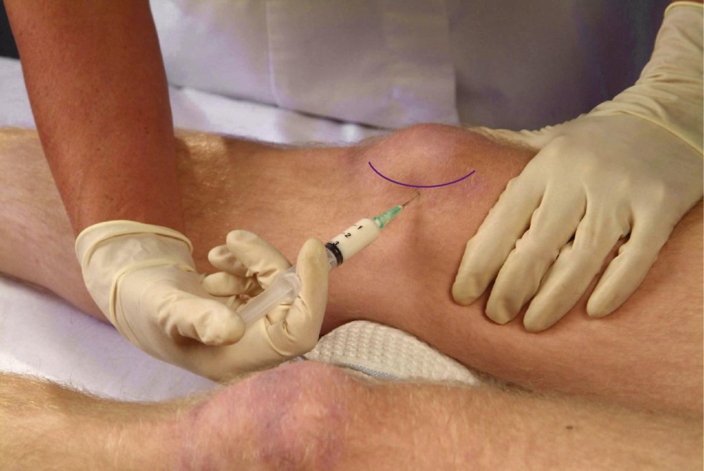injecție intraarticulară de medicamente în articulația genunchiului