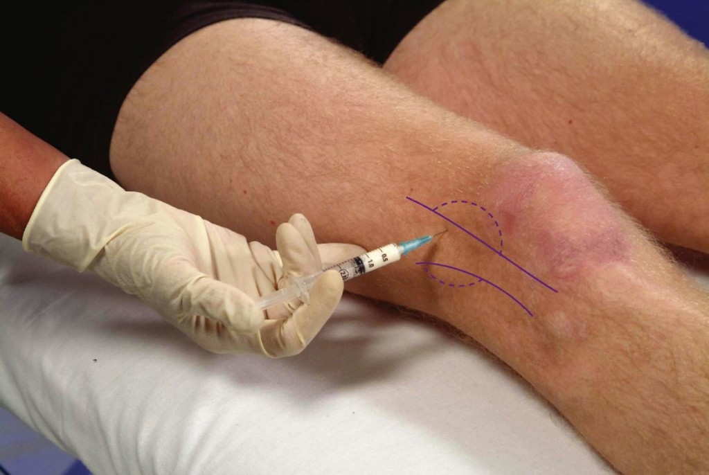 injecție de durere la genunchi